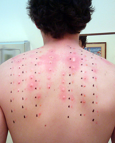 4 FAQs About Allergy Testing 4 FAQs About Allergy Testing