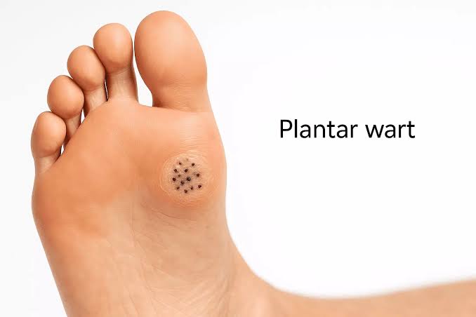 Effective Practices for Preventing Warts Effective Practices for Preventing Warts