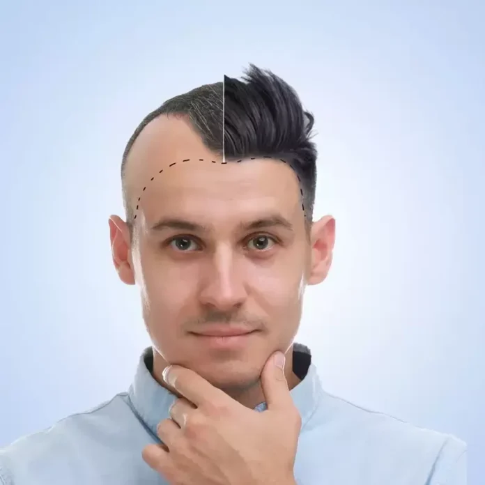 Exploring the Different Techniques of Hair Transplant Surgery Exploring the Different Techniques of Hair Transplant Surgery