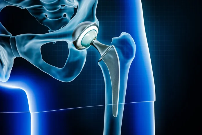 Factors Influencing the Success of Hip Replacement Surgery Factors Influencing the Success of Hip Replacement Surgery