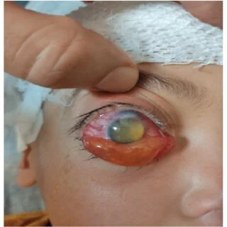 How To Differentiate Between an Eye Cyst and Other Eye Conditions How To Differentiate Between an Eye Cyst and Other Eye Conditions