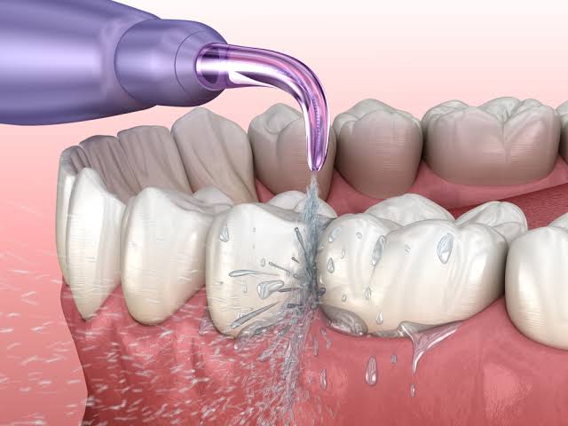 How a Dentist Will Help With Crowns and Implants How a Dentist Will Help With Crowns and Implants