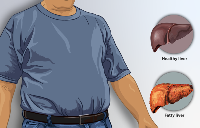 Identifying Liver Disease Symptoms Identifying Liver Disease Symptoms