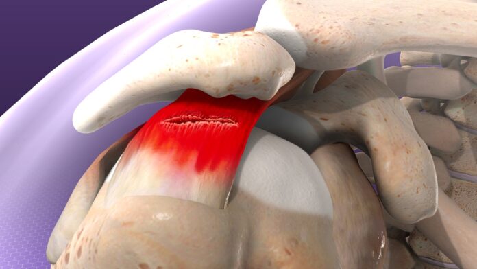Identifying the Symptoms of a Rotator Cuff Tear and When to Seek Help Identifying the Symptoms of a Rotator Cuff Tear and When to Seek Help