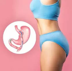 Navigating the Gastric Bypass Surgery Process Navigating the Gastric Bypass Surgery Process