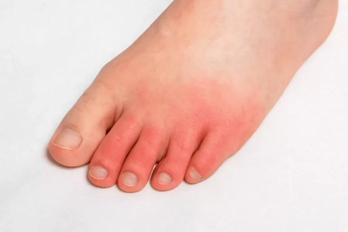 Recognizing the Signs of a Severe Ankle Sprain Recognizing the Signs of a Severe Ankle Sprain