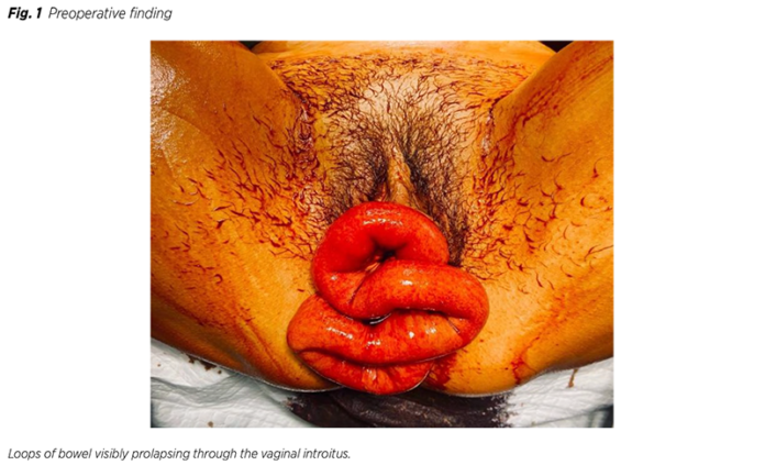 The Role of Hysterectomy in Treating Severe Gynecological Conditions The Role of Hysterectomy in Treating Severe Gynecological Conditions