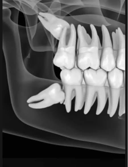 Tips for Preventing Cracked Teeth Tips for Preventing Cracked Teeth
