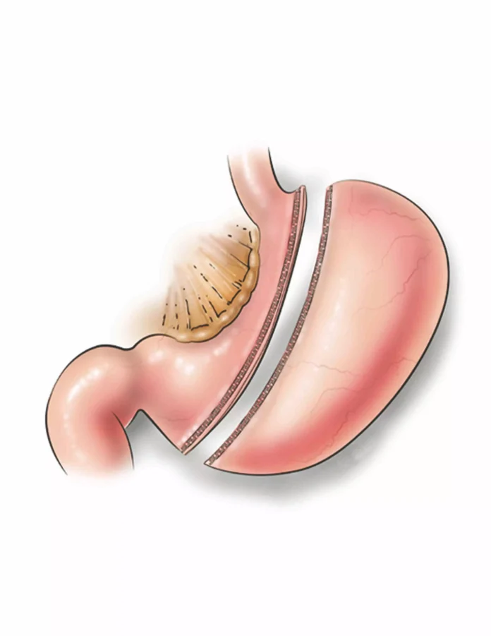 Understanding Bariatric Surgery Options Understanding Bariatric Surgery Options