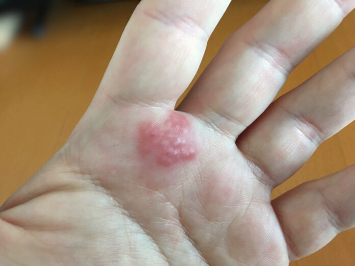 Understanding Eczema Triggers and How To Manage Symptoms Understanding Eczema Triggers and How To Manage Symptoms
