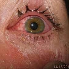 Understanding Pink Eye and How To Manage It Understanding Pink Eye and How To Manage It