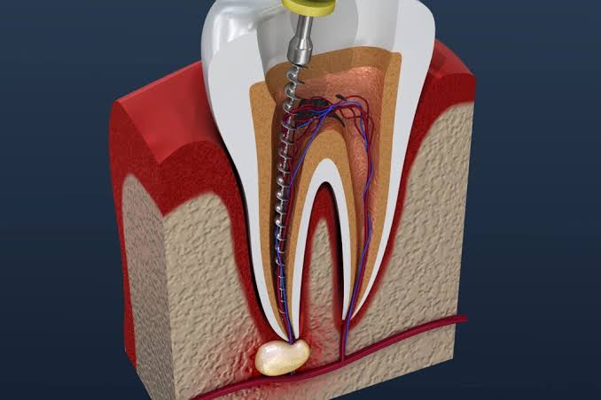 Understanding Post-Procedure Care After a Root Canal Understanding Post-Procedure Care After a Root Canal