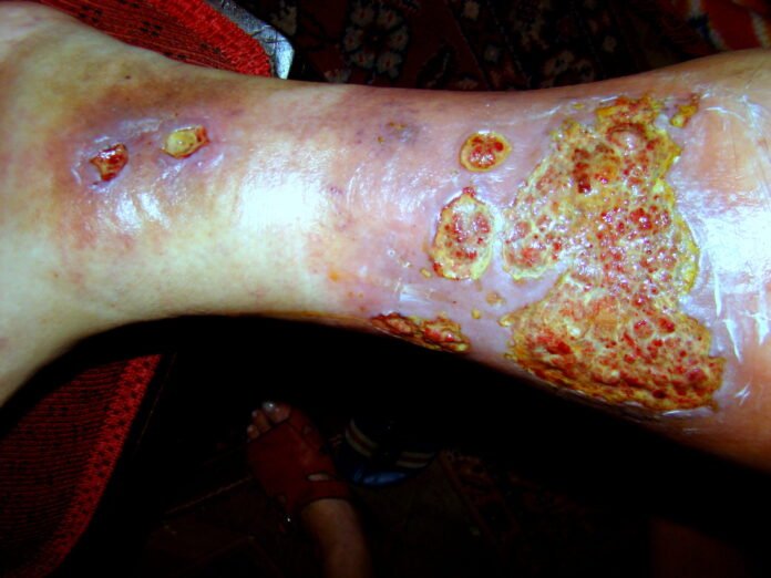 Understanding the Challenges of Venous Ulcers and Treatment Solutions Understanding the Challenges of Venous Ulcers and Treatment Solutions