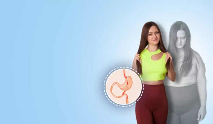 Understanding the Role of Bariatric Surgery in Long-Term Weight Management Understanding the Role of Bariatric Surgery in Long-Term Weight Management