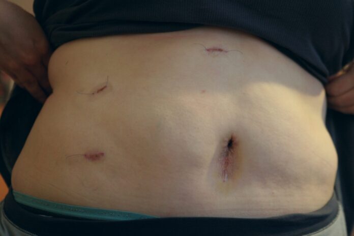 What Happens to Your Body After Gallbladder Removal What Happens to Your Body After Gallbladder Removal?