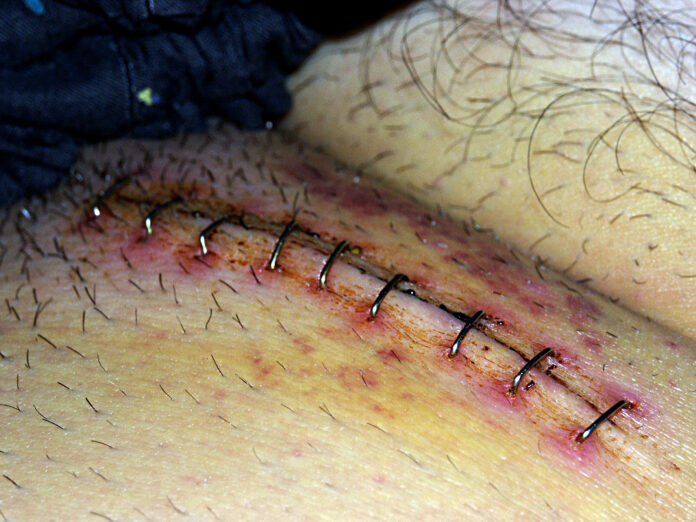 What Patients Should Know About Hernia Surgery What Patients Should Know About Hernia Surgery
