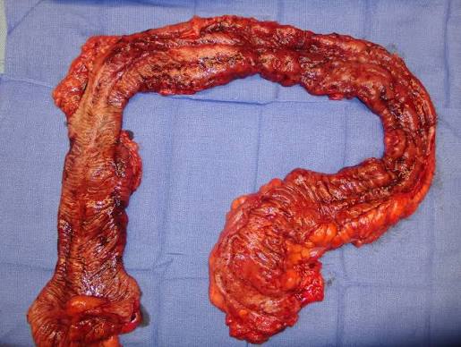 What To Know About Ulcerative Colitis What To Know About Ulcerative Colitis