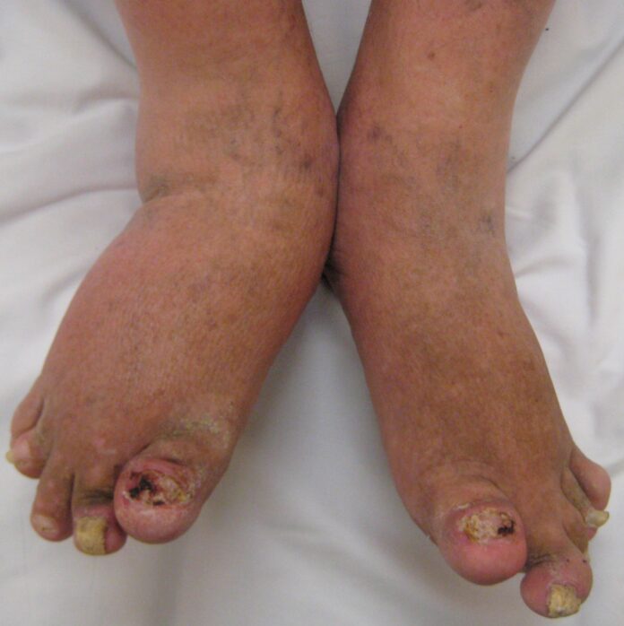When To Seek Treatment for Psoriatic Arthritis When To Seek Treatment for Psoriatic Arthritis