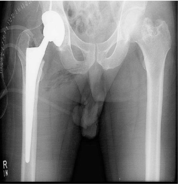 Benefits of Follow-Up Care After Joint Replacement Benefits of Follow-Up Care After Joint Replacement