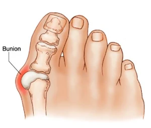 How to Treat Bunions in Seniors How to Treat Bunions in Seniors