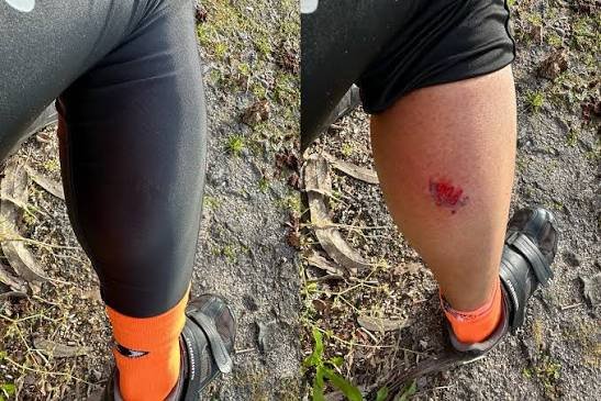 What to Expect After an Animal Bite What to Expect After an Animal Bite